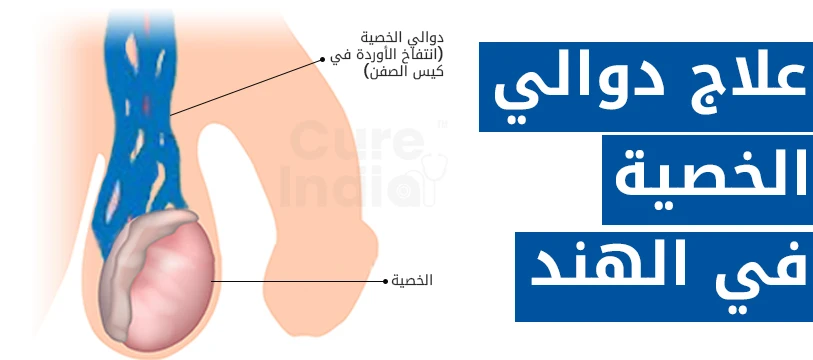 عملية دوالي الخصية في الهند
